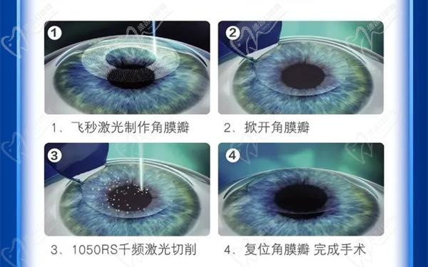 庞辰久近视手术