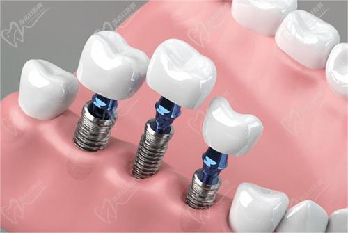 种牙骨粉 种牙骨粉