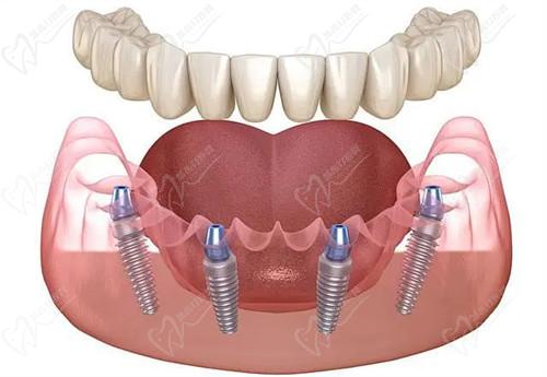 种牙骨粉需要多少钱 种牙骨粉需要多少钱
