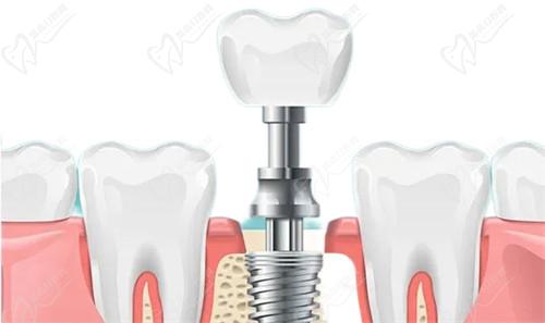 种牙骨粉是什么做成的 种牙骨粉是什么做成的