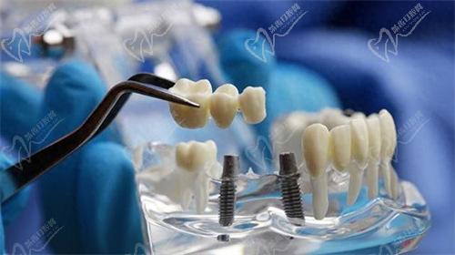 种牙骨粉需要多久可以变成骨头 种牙骨粉需要多久可以变成骨头