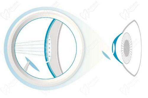 沈政伟近视手术技术高超