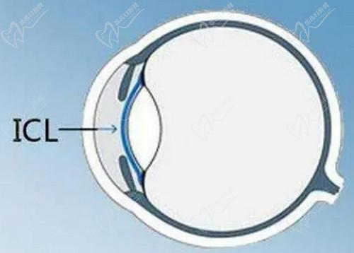 沈政伟近视手术技术出色