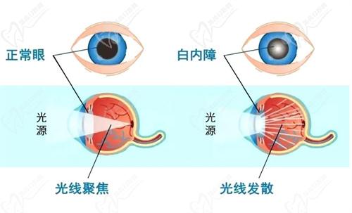 镇江【 】眼科白内障