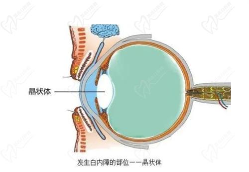 镇江【 】眼科白内障手术价格