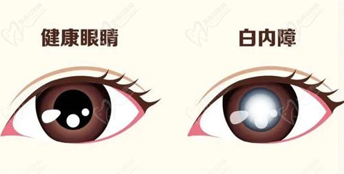 白内障手术适用人群