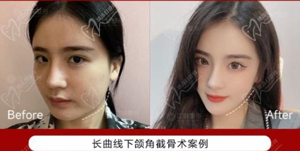 武汉刘骏长曲线下颌角截骨术技术优势及实例分享
