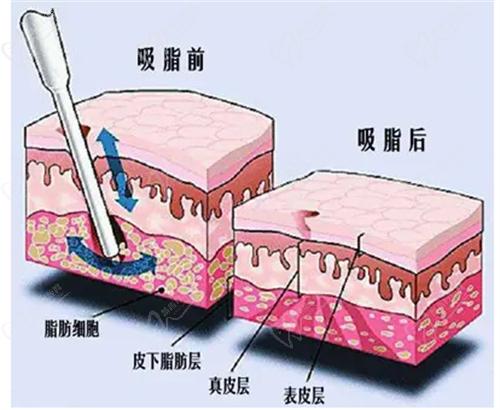 武汉江城整形刘骏医生吸脂技术高超