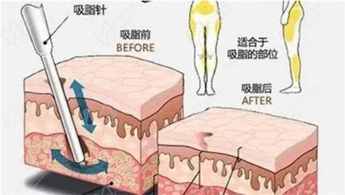 武汉江城整形刘骏医生擅长做艺术体雕