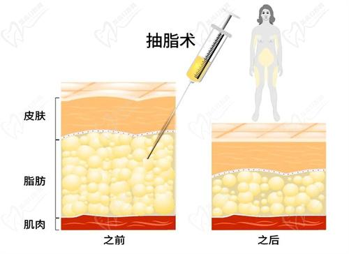 武汉江城整形刘骏医生吸脂技术好
