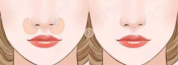 范荣杰鼻子整形