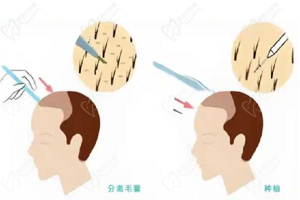 成都植发医院排名
