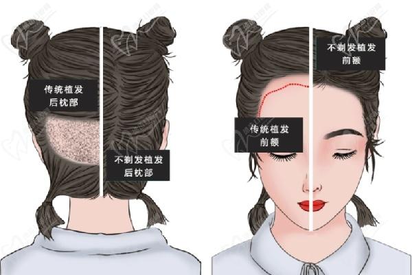 成都植发董美龄医生