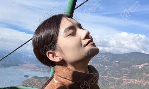 卢元刚初次鼻综合手术30天对比