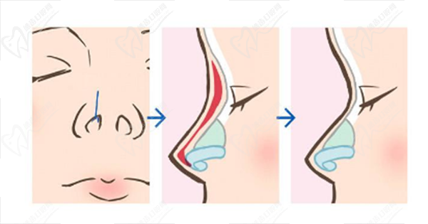 常州曙光整形鼻部综合项目