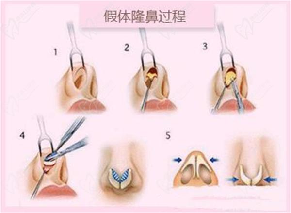 常州曙光整形鼻部综合项目