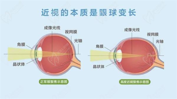 王乐今后巩膜加固术