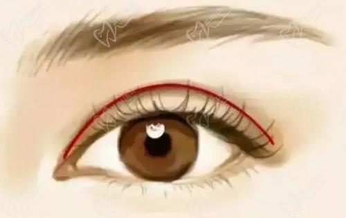 安康维美丽莎美容彭以建的双眼皮技术扎实