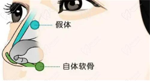 安康维美丽莎美容彭以建隆鼻技术也不错