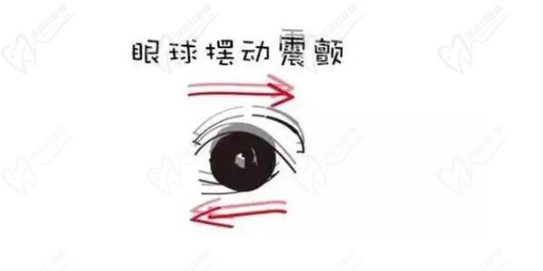 眼球震颤