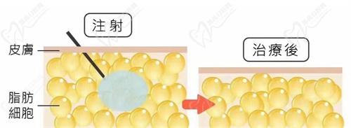 钟杰光医生脂肪填充费用