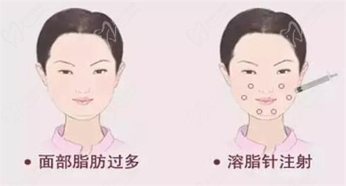 广州钟杰光医生费用