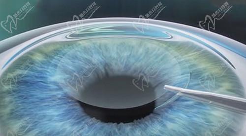 武汉佰视佳眼科周跃明医生的全飞秒近视手术技术十分娴熟 武汉佰视佳眼科周跃明医生的全飞秒近视手术技术十分娴熟