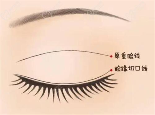 郑小红医生修复双眼皮真【 】