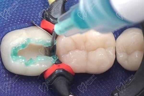 银川诺贝尔口腔医院补牙医生
