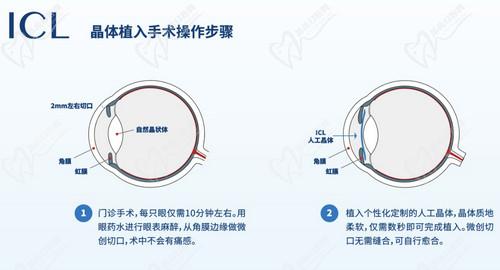 武汉华厦眼科医院ICL晶体植入手术技术娴熟