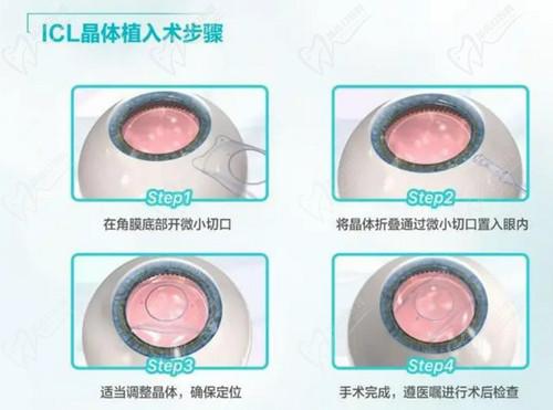 武汉华厦眼科医院张光明医生ICL晶体植入手术价格