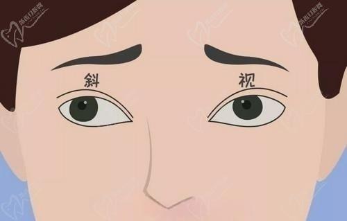 武汉华厦眼科医院戴鸿斌院长斜视矫正手术高超