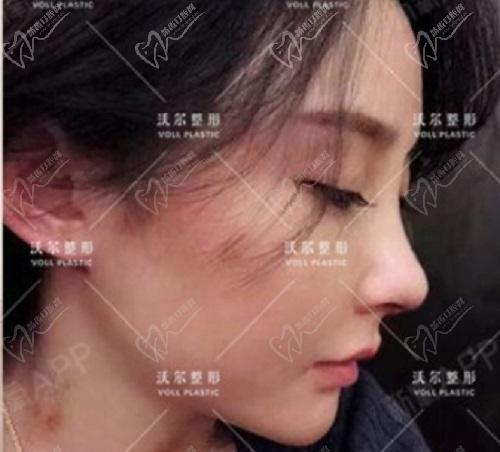刘彦军做鼻子实例