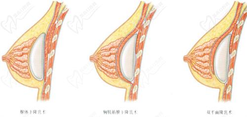 林沸腾隆胸排名