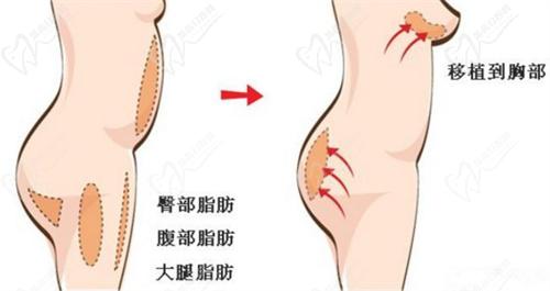 脂肪丰胸1.jpg