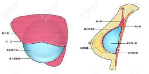 林沸腾隆胸排名：林沸腾是国内十大隆胸医生