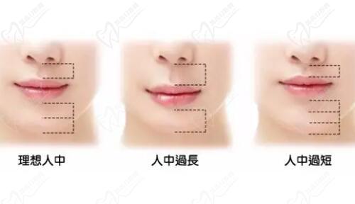 郑州杨胜发做人中缩短怎么样