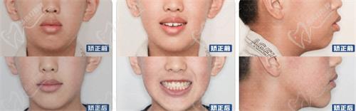 张栋梁医生开唇露齿、下巴后缩,牙齿矫正实例图片 张栋梁医生开唇露齿、下巴后缩,牙齿矫正实例图片