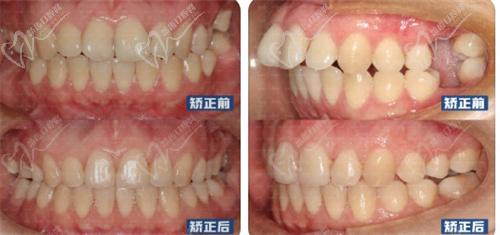 张栋梁医生嘴凸下巴后缩缺失牙,牙齿矫正改善侧貌实例图片 张栋梁医生嘴凸下巴后缩缺失牙,牙齿矫正改善侧貌实例图片