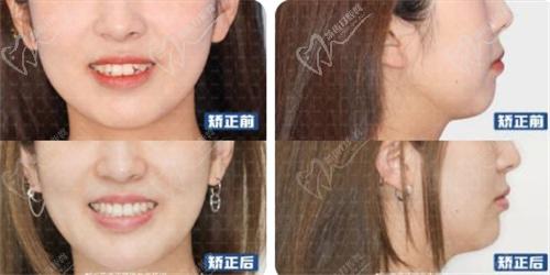 张栋梁医生不拔牙矫正解除上颌前突、下颌后缩实例图片 张栋梁医生不拔牙矫正解除上颌前突、下颌后缩实例图片