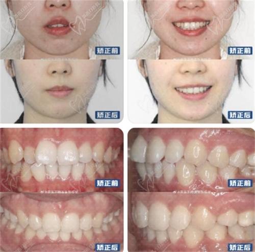 张栋梁医生双颌前突、下巴后缩,牙齿矫正导出下巴实例图片 张栋梁医生双颌前突、下巴后缩,牙齿矫正导出下巴实例图片