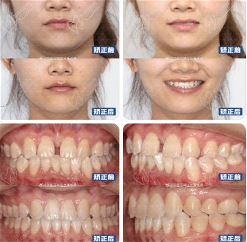 张栋梁医生面中凹陷、牙齿不齐,牙齿矫正调整面型实例图片 张栋梁医生面中凹陷、牙齿不齐,牙齿矫正调整面型实例图片