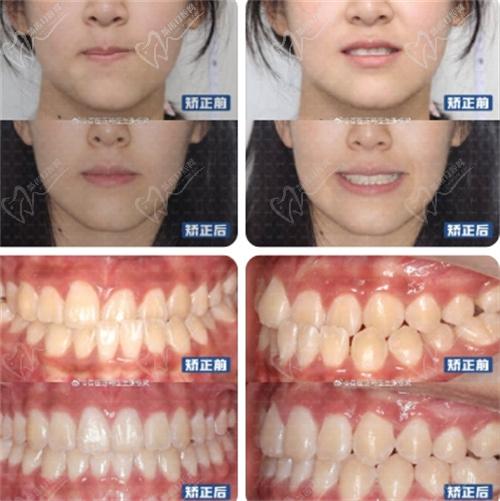 张栋梁医生青少年地包天面型,不拔牙矫正改善实例图片 张栋梁医生青少年地包天面型,不拔牙矫正改善实例图片