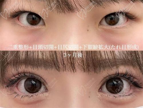 那么，西安董潇双眼皮到底怎么样？