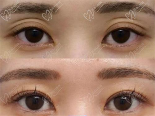 西安董潇双眼皮怎么样？