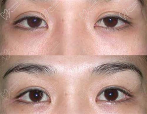 西安董潇双眼皮哪个医院？