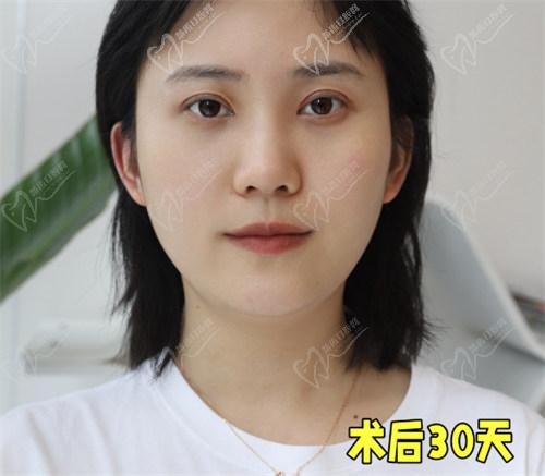 西安董潇双眼皮手术常见问题解答