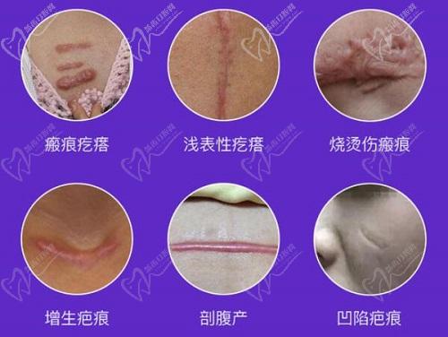 谷培俊医生做疤痕手术好吗？
