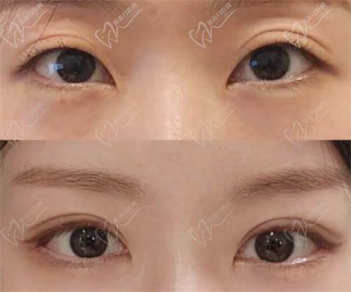 二、【西安美莱医疗整形收费标准】双眼皮手术价格表：