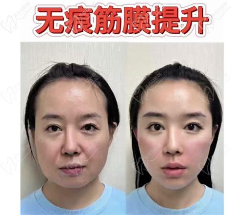 三、【西安美莱医疗整形收费标准】祛斑价格表：